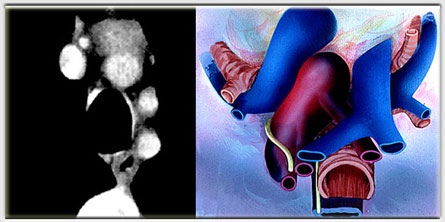 Right innominate vein