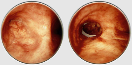 Bronchial Stenosis